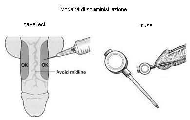 How to Apply Vitaros Cream: Step-by-Step Guide from a Real User Illustration of topical ED cream application area